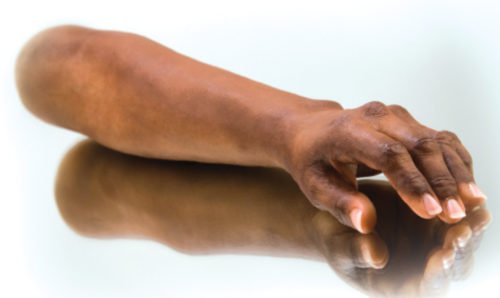 Prótesis antebrazo izquierdo * Anaplastología