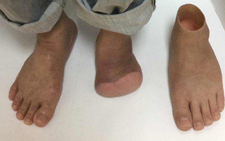 Amputación Lisfranc