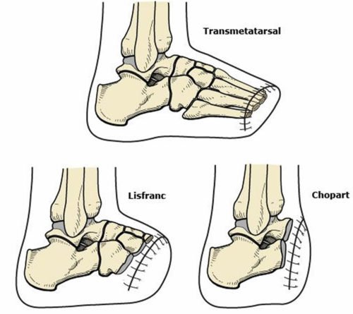 Amputaciones Transmetatarsal, Lisfranc y Chopart * ART LAB