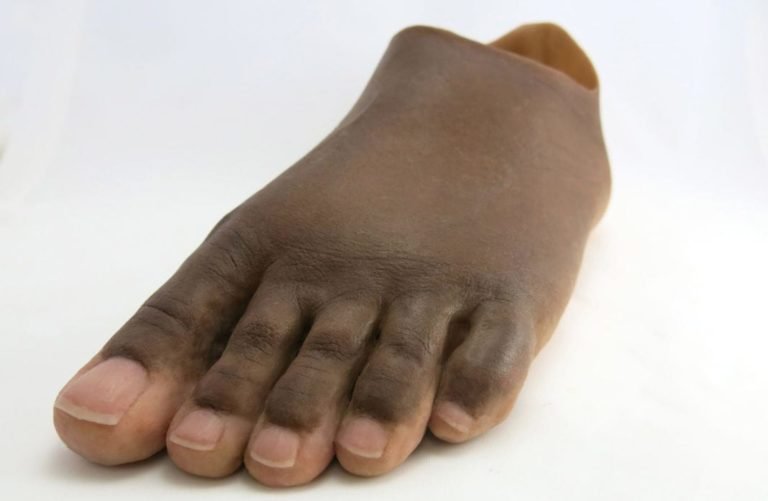 Prótesis pie izquierdo * Diplomado prótesis