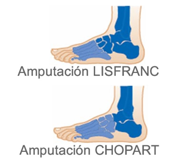 Amputación Lisfranc (tarso metatarsiana) y Chopart (mediotarsiana) * ART LAB