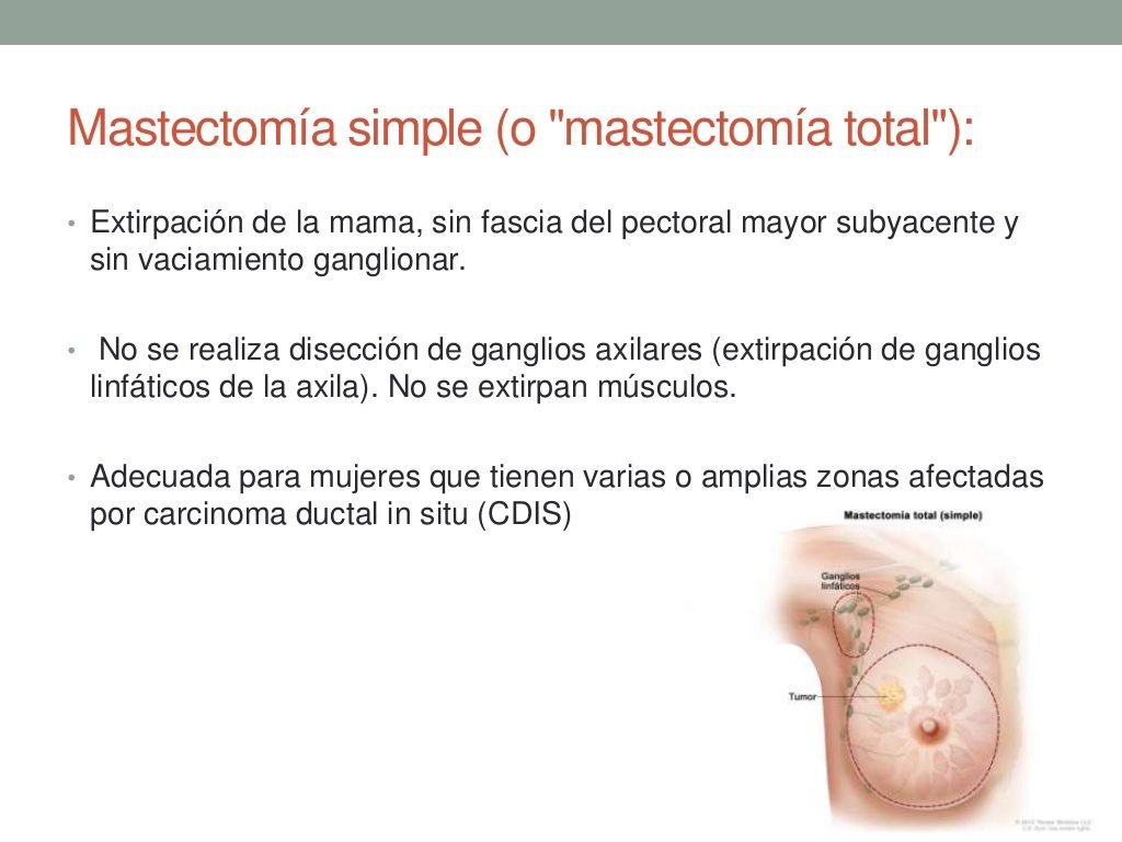 Mastectomia Simple X Prótesis ART LAB * Mastectomía simple