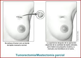 Mastectomia Parcial Prótesis ART LAB * Mastectomía parcial