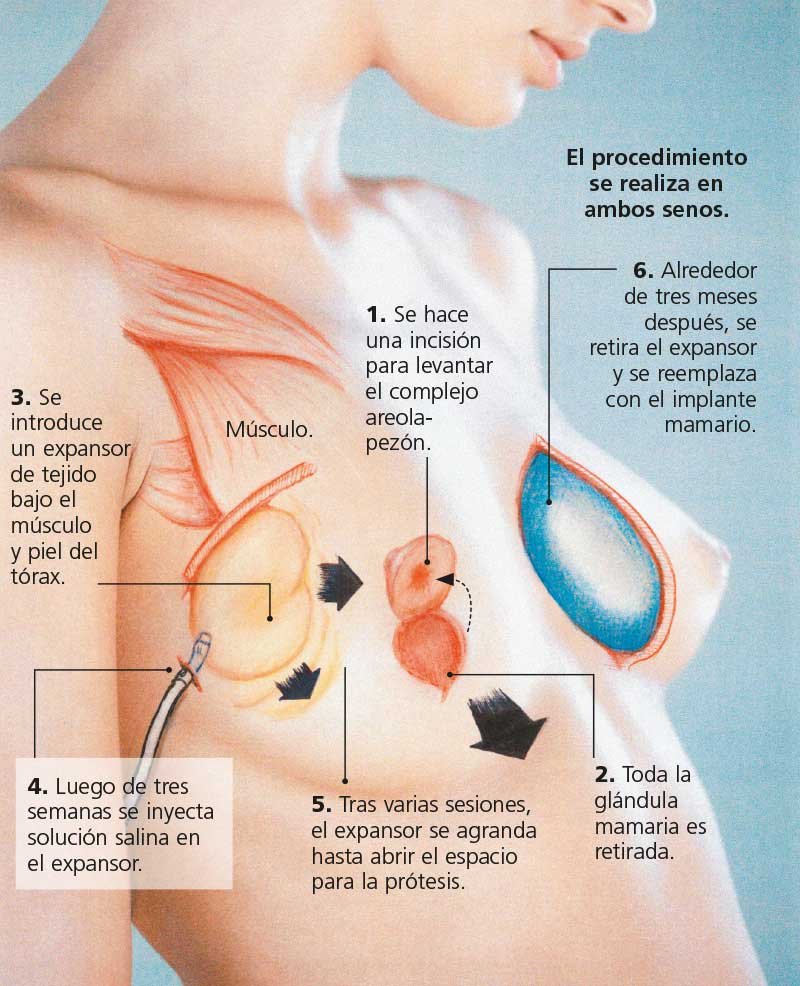 Mastectomía preventiva *  ART LAB