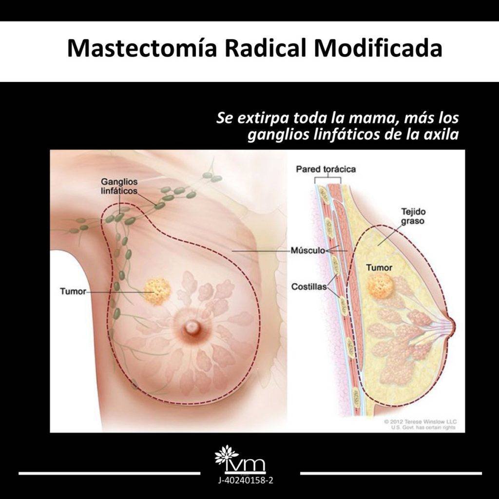Mastectomia Radical X Prótesis ART LAB * Mastectomía radical
