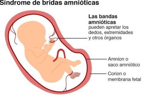 Síndrome de bridas amnióticas * ART LAB