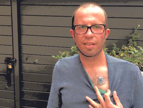 Liviu Babitz implante en el torax que incluye brújula y conexión Bluetooth * ART LAB