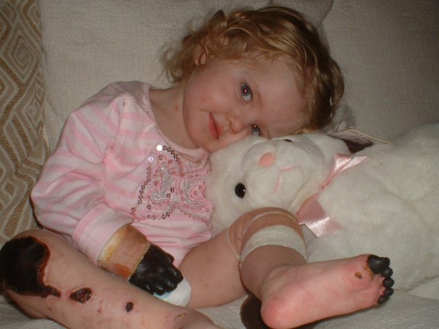 Tilly Lockey a los 15 meses con necrosis por infección * ART LAB