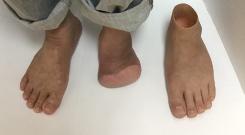 Amputación transmetatarsiana y su prótesis * ART LAB