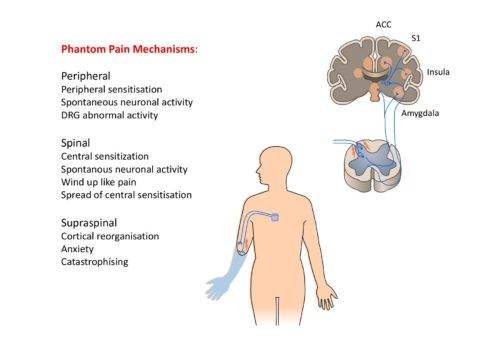 Como viaja el dolor al cerebro * ART LAB