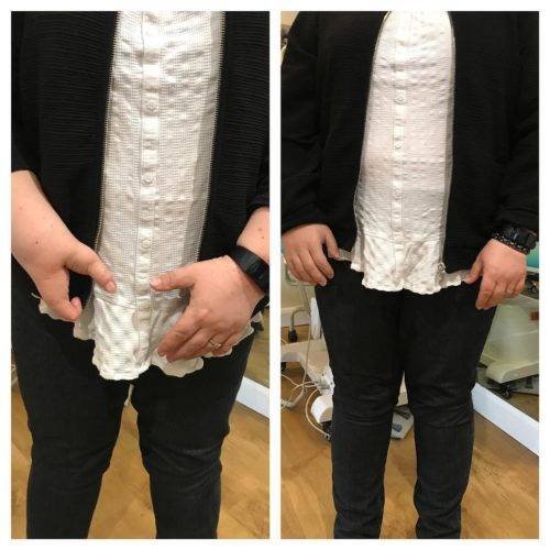 Ectrodactilia y prótesis de silicona * ART LAB