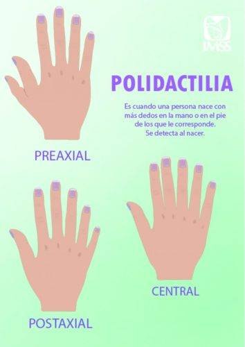 Polidactilia * ART LAB