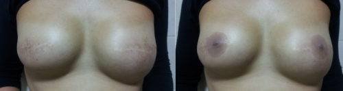 Prótesis pezón * Prothesis ART LAB