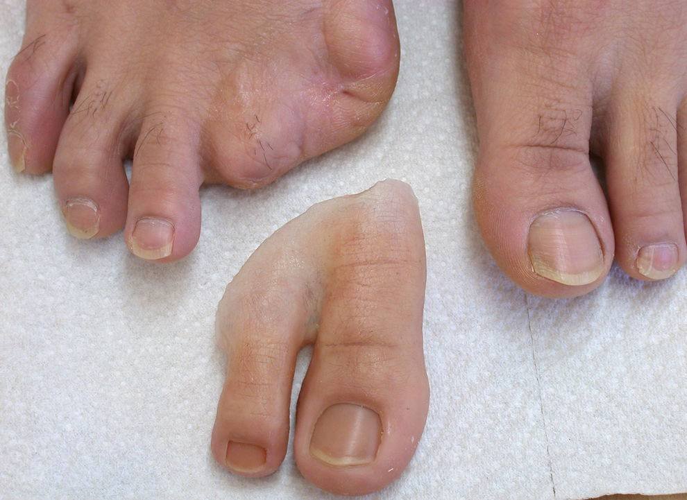 Protesis Para Amputacion Del Dedo Gordo Del Pie Prótesis para amputación del dedo gordo del pie