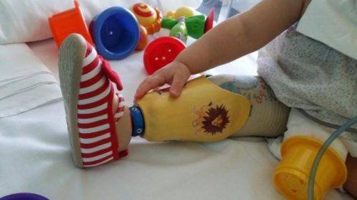 Bebé con prótesis de pierna