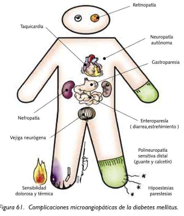 Complicaciones diabetes mellitus