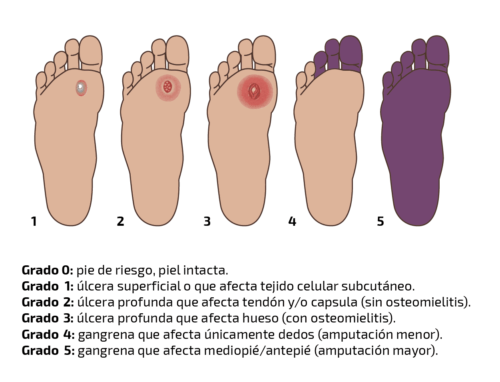 Clasificación del pie diabético * ART LAB