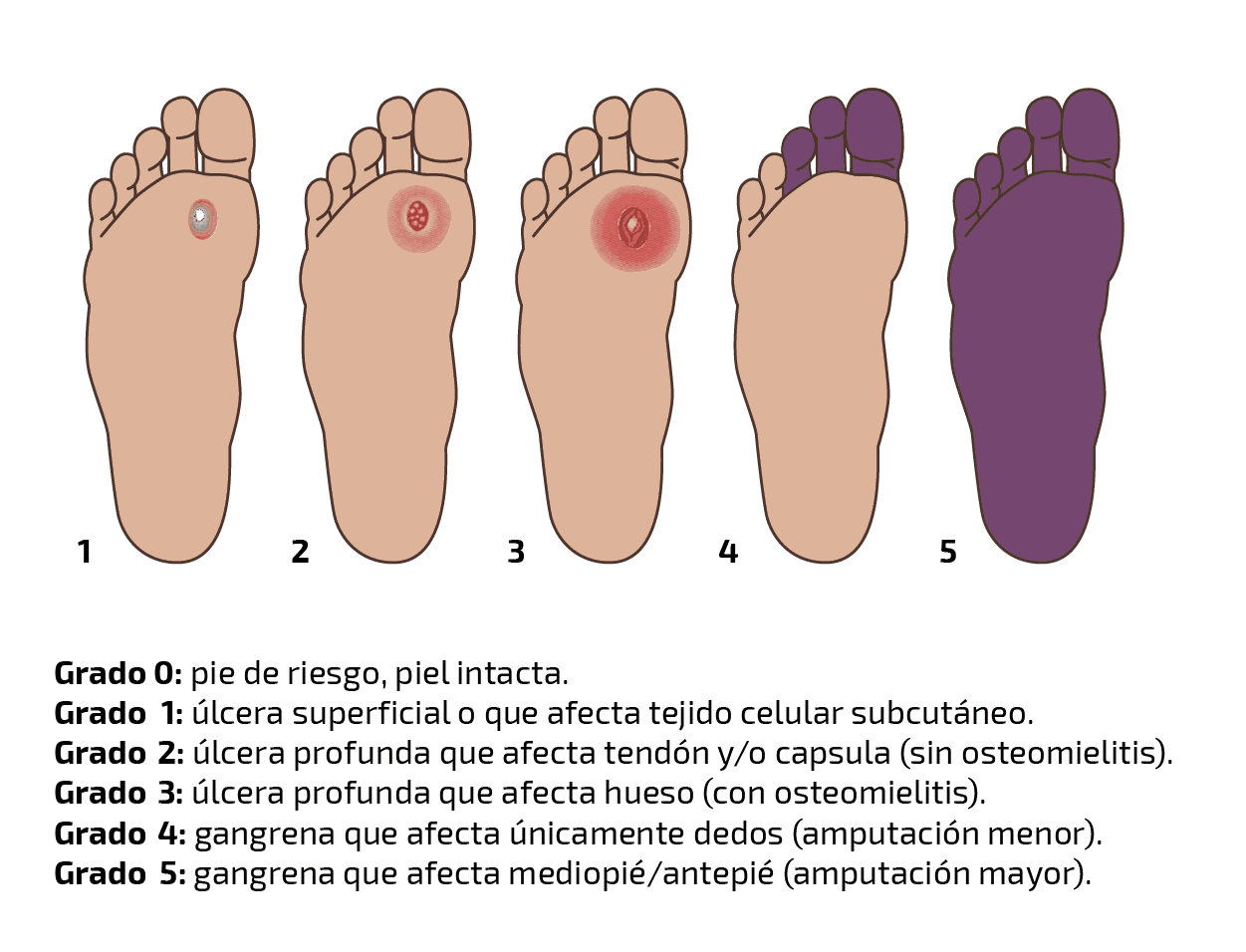 Clasificación del pie diabético * ART LAB