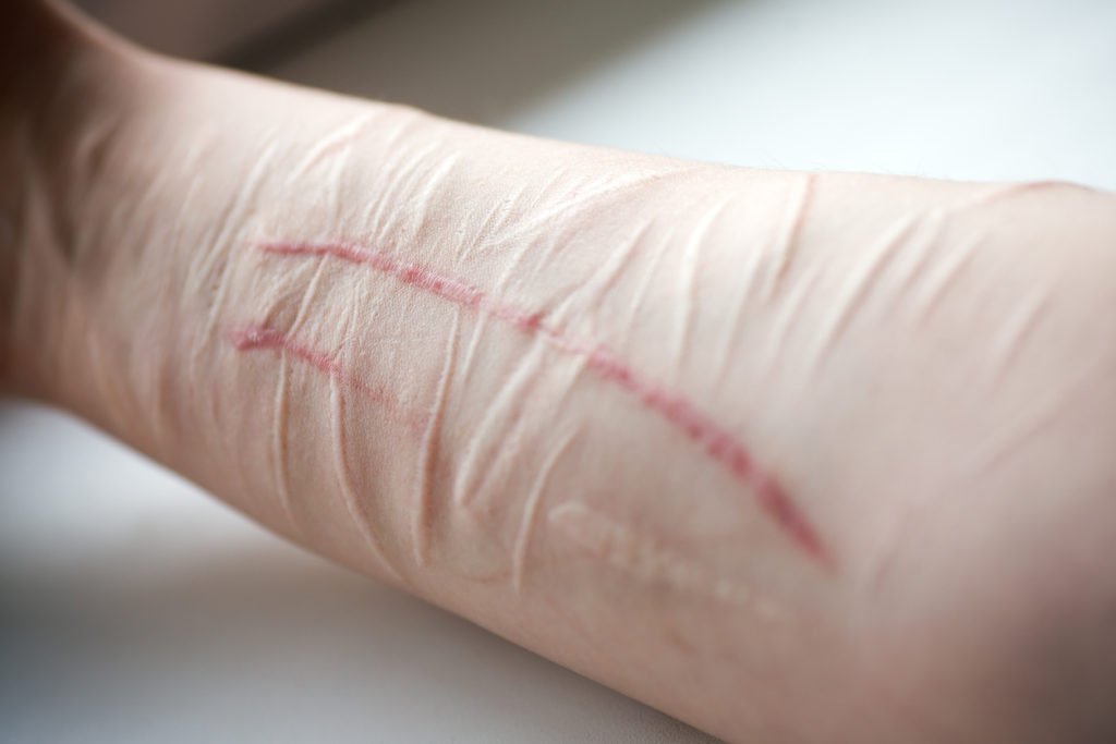 Risuka, Cutting, Self Injury, Autolesión