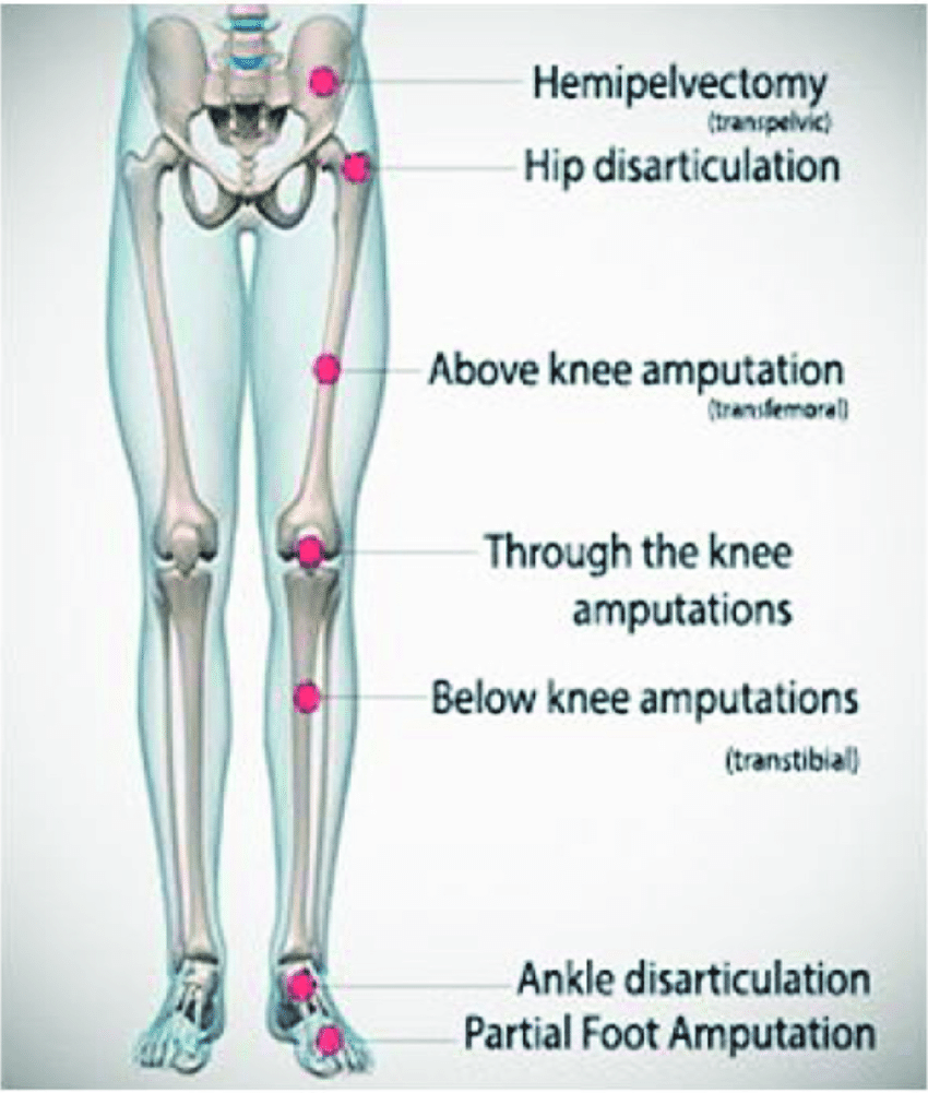 Levels-of-amputation - Amputations in diabetic patient