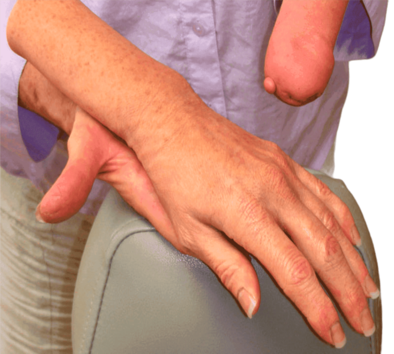 Prótesis Hiperrealistas Para Manos