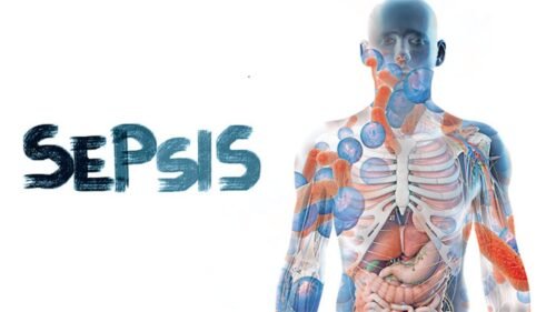Sepsis