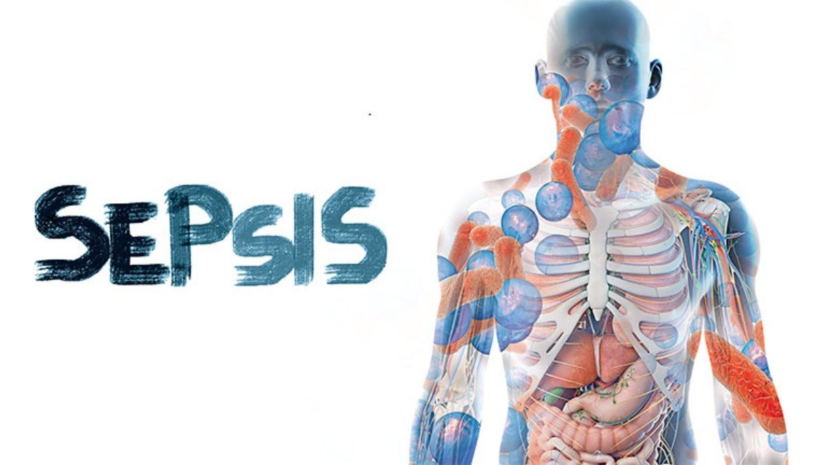 sepsis - Sepsis