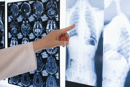 Diagnostico del cáncer de huesos * ART LAB