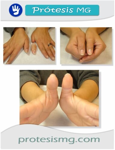 Prótesis De Dedos