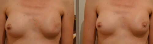 Prótesis para pezón y areola perdidos por mastectomía * ART LAB