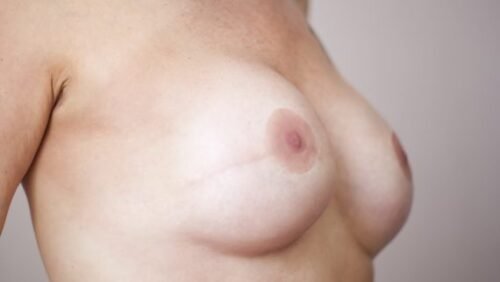 Prótesis para pezón y areola perdidos por mastectomía * ART LAB