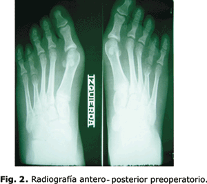 Tratamiento de la braquimetatarsia mediante elongación ósea con minifijador externo 2 * ART LAB