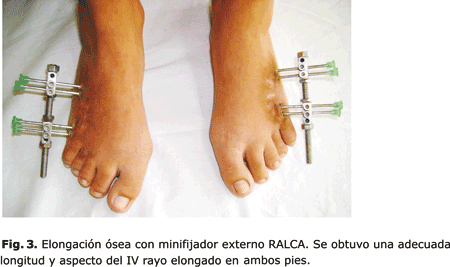 Tratamiento de la braquimetatarsia mediante elongación ósea con minifijador externo 3 * ART LAB