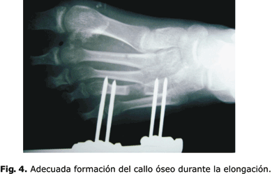 Tratamiento de la braquimetatarsia mediante elongación ósea con minifijador externo 4 * ART LAB
