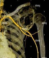 Tumores malignos de los huesos Condrosarcoma