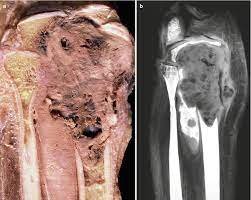 Tumores malignos de los huesos Fibrosarcoma * ART LAB