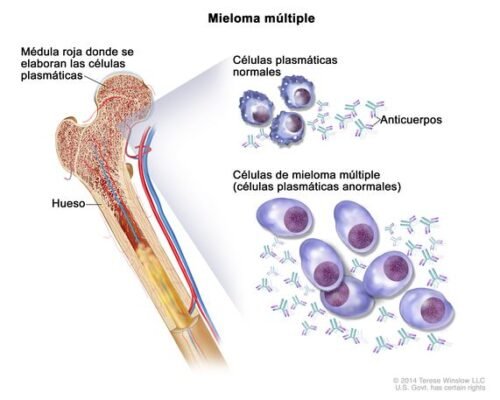 Tumores malignos de los huesos Mieloma * ART LAB