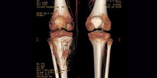 Tumores malignos de los huesos Osteosarcoma * ART LAB