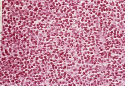 Tumores malignos de los huesos Reticulosarcoma * ART LAB