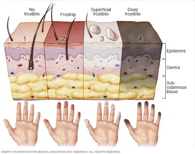 Frostbite occurs when your skin freezes during exposure to freezing temperatures. Frostbite symptoms can include pain, numbness, swelling, blisters and skin discoloration. It’s most common on your fingers, toes, nose, and ears. Treatment for frostbite varies based on the stage.