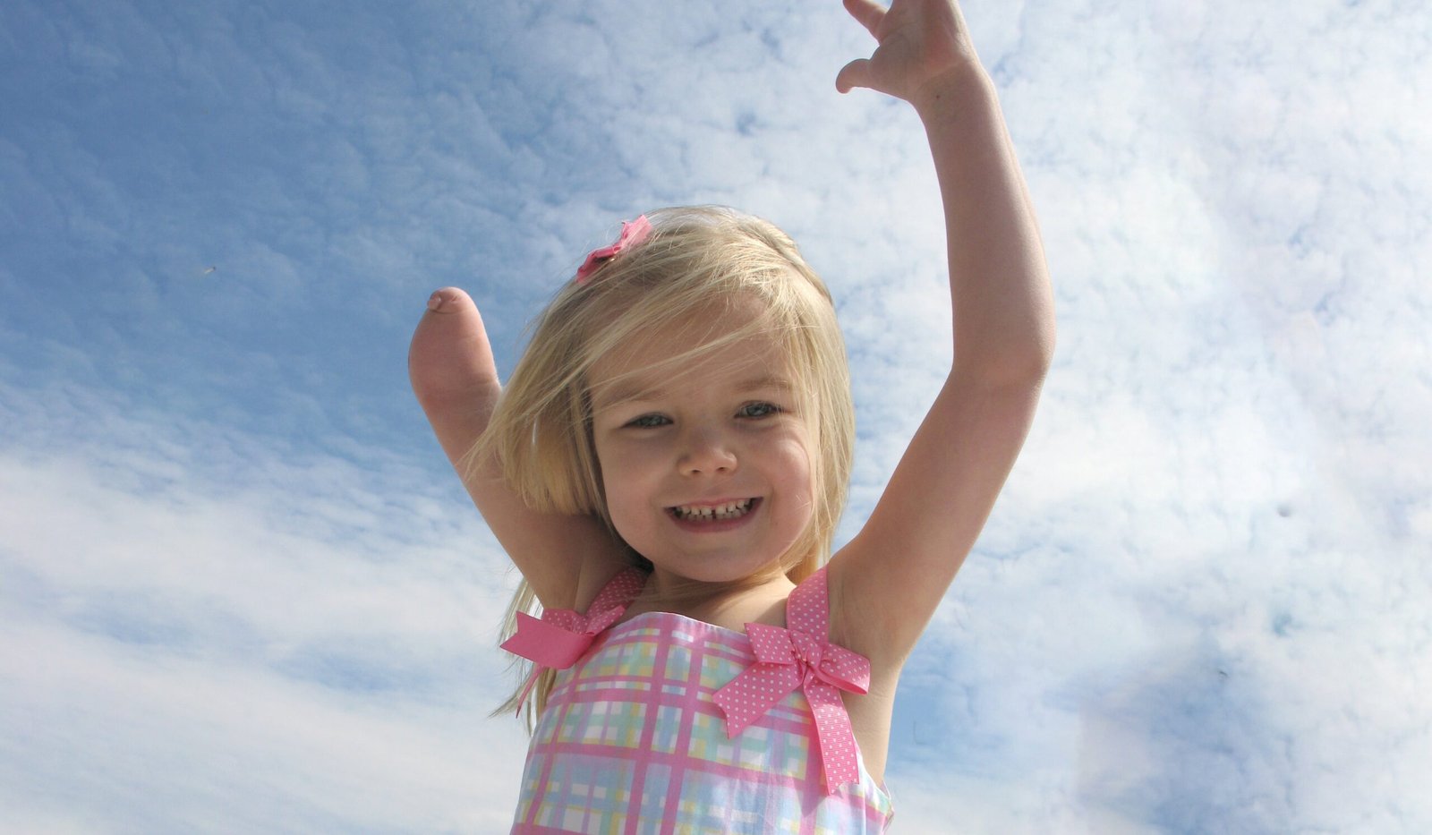 A congenital amputation means a limb is not formed correctly. Or is missing at birth. This happens while the limb is being. Formed in the womb.