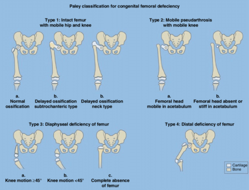 Congenital femur deficiency classification