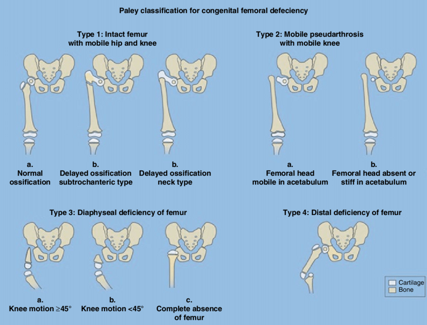 Congenital deficiency of the femur (CFD) is a spectrum of disorders which includes proximal focal femoral deficiency (PFFD), coxa vara, hypoplastic and congenital short femur.