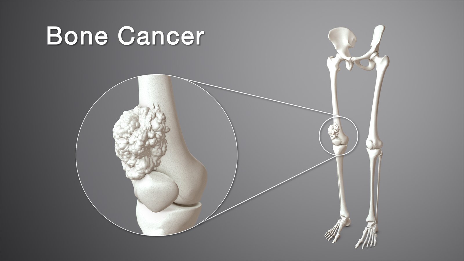 Osteosarcoma is the most common histological form of primary bone sarcoma. It is most prevalent in teenagers and young adults.