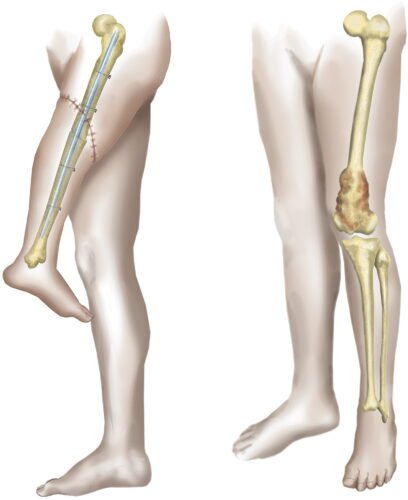 Rotationplasty