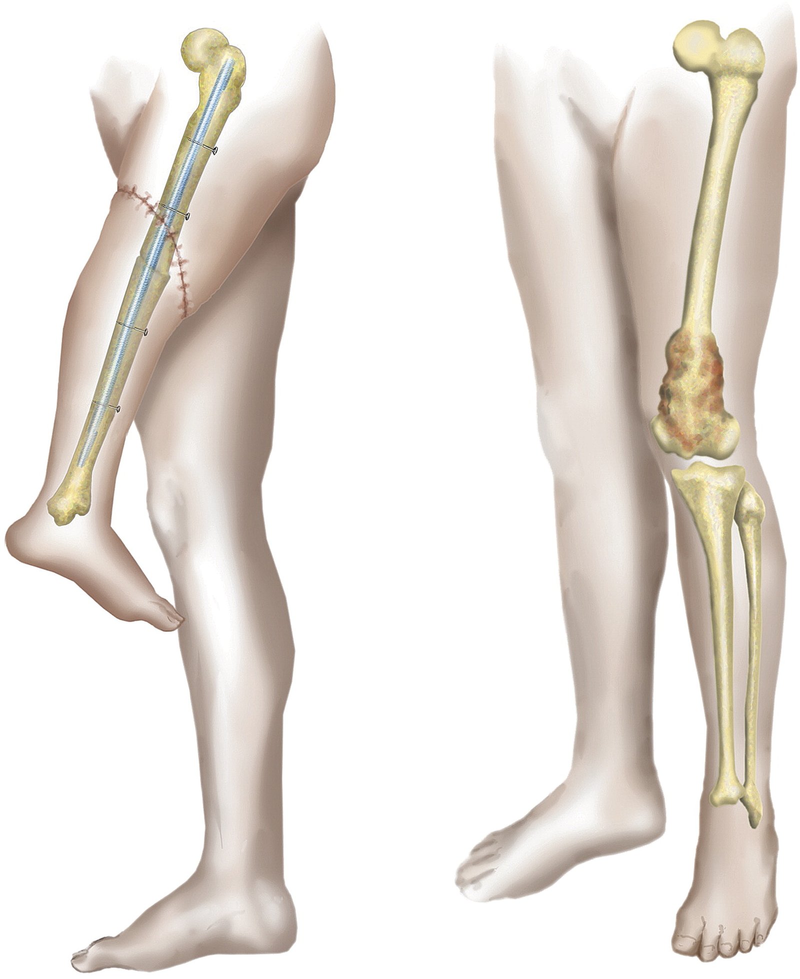 Rotationplasty is a surgical procedure used to treat bone tumors in children that occur near the knee.