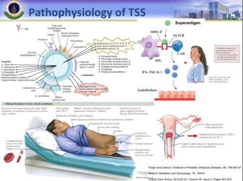 Toxic shock syndrome TSS