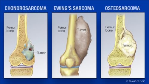Types bone cancer