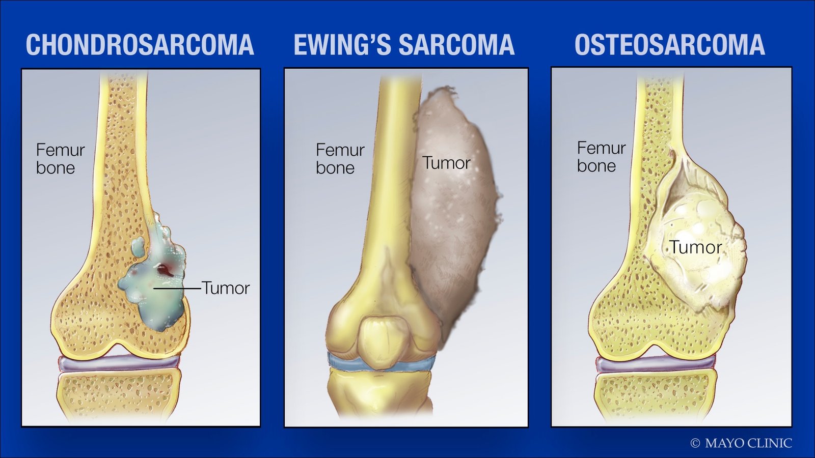 There are several different types of bone cancer. Most primary bone cancers are in the category of tumors called sarcomas, a kind of cancer that can affect soft tissues such as muscles and nerves as well as bone. Sarcomas have a diverse range of features at the molecular and cellular level. Because of that, not all bone sarcomas respond to the same types of treatment.