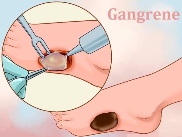 Gangrene is a type of tissue death caused by a lack of blood supply. Symptoms may include a change in skin colour to red or black, numbness, swelling, pain, skin breakdown, and coolness. The feet and hands are most commonly affected. If the gangrene is caused by an infectious agent, it may present with a fever or sepsis.